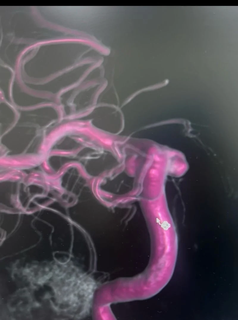 Sarfraz Ahmad: Diagnostic and Therapeutic Challenges in ICA Aneurysm Presenting With Epistaxis 1 Sarfraz Ahmad: Diagnostic and Therapeutic Challenges in ICA Aneurysm Presenting With Epistaxis