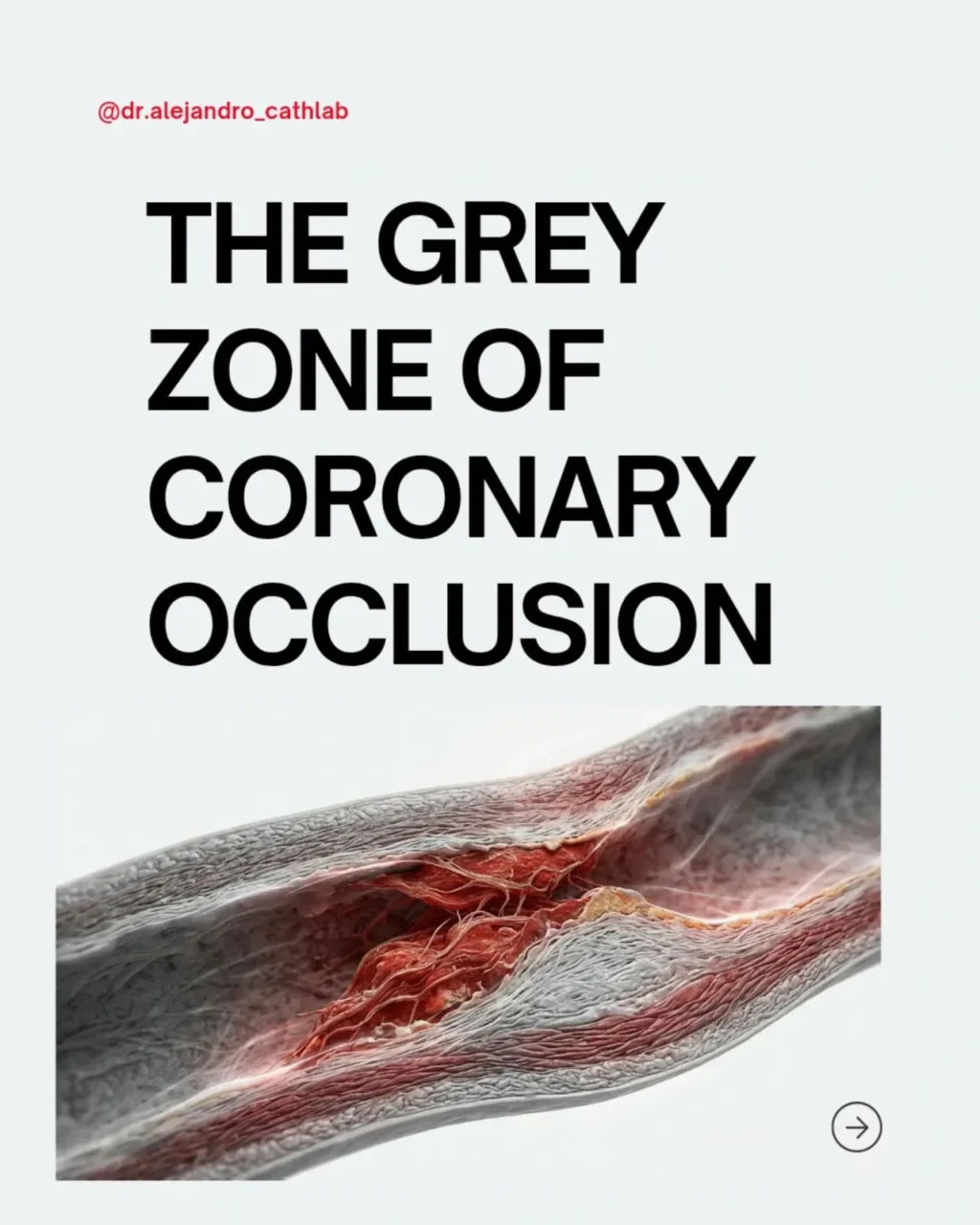 Alejandro González Veliz: SCO May Be One of the Most Misunderstood Areas in Interventional Cardiology 1 Alejandro González Veliz
