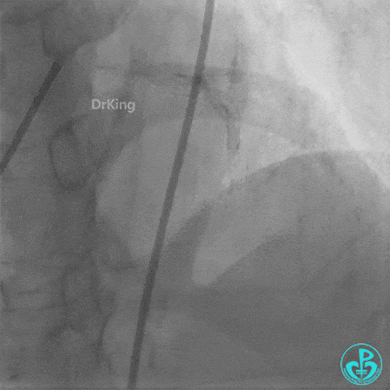 Haichang Wang: The Nightmare Case on Recurrent Subacute LAD Ostial Stent Thrombosis