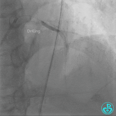 Haichang Wang: The Nightmare Case on Recurrent Subacute LAD Ostial Stent Thrombosis
