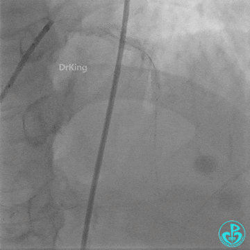 Haichang Wang: The Nightmare Case on Recurrent Subacute LAD Ostial Stent Thrombosis