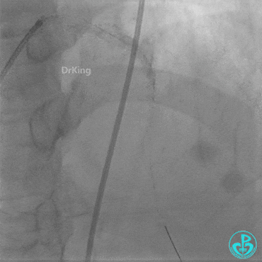 Haichang Wang: The Nightmare Case on Recurrent Subacute LAD Ostial Stent Thrombosis