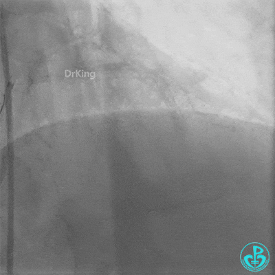 Haichang Wang: The Nightmare Case on Recurrent Subacute LAD Ostial Stent Thrombosis