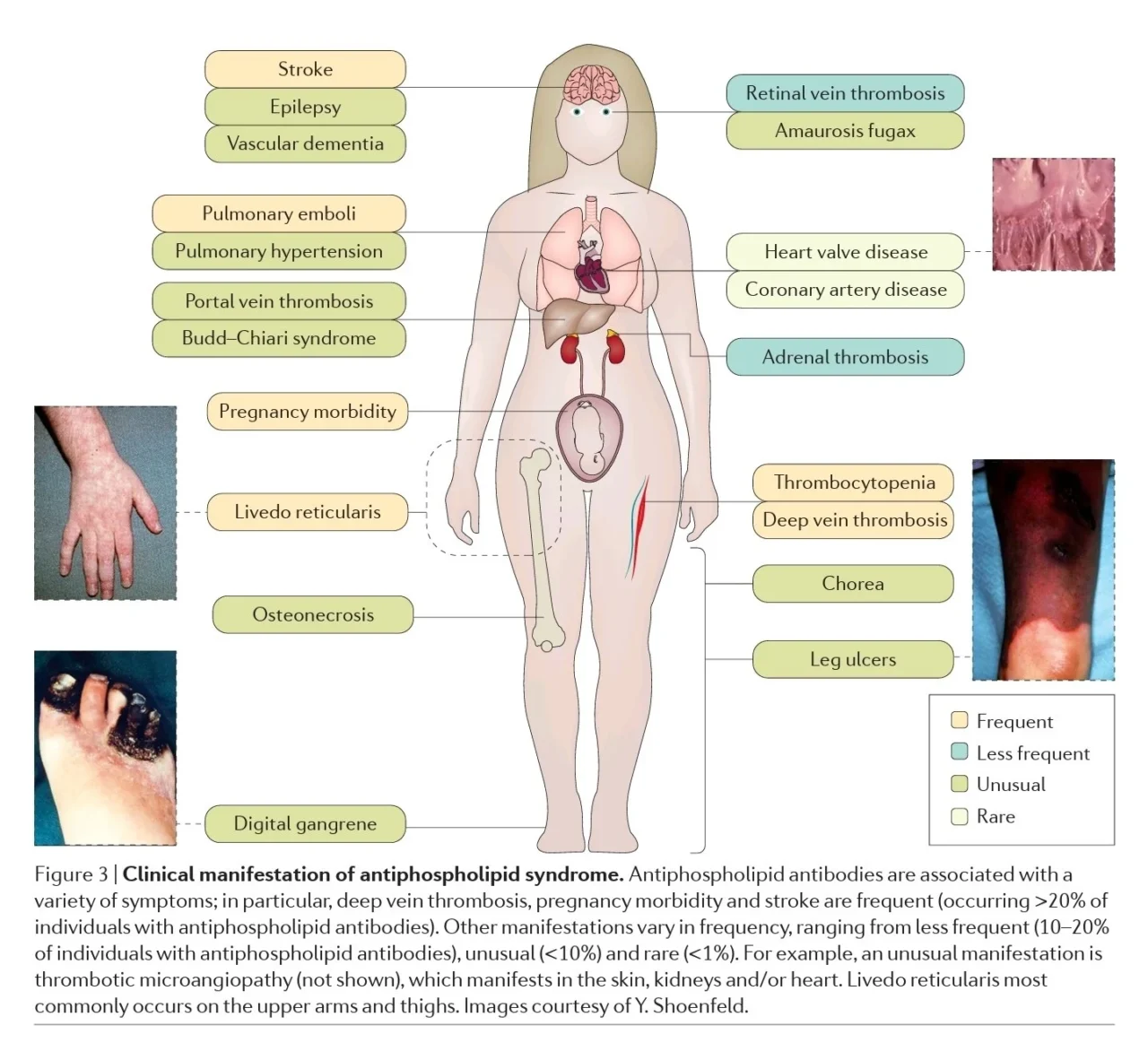 W. Alberto Sifuentes Giraldo: An Overview of Thrombotic Risk and Diagnostic Criteria in Antiphospholipid Syndrome