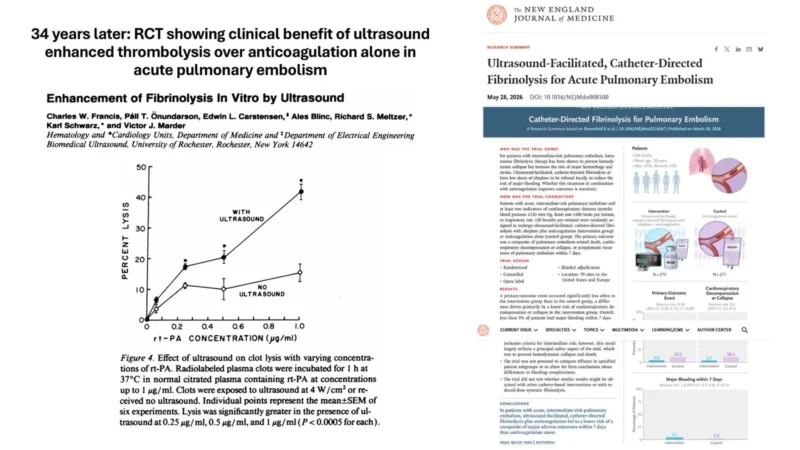Pall T. Onundarson: The 3-Decade Journey of Ultrasound-Enhanced Fibrinolysis in PE 1 Pall T. Onundarson: The 3-Decade Journey of Ultrasound-Enhanced Fibrinolysis in PE
