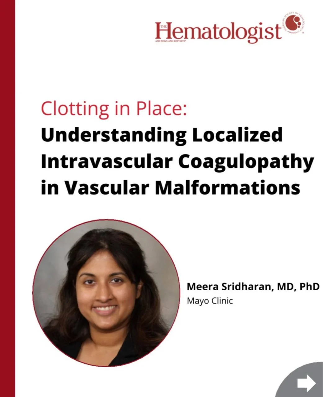 Understanding Localized Intravascular Coagulopathy in Vascular Malformations - ASH