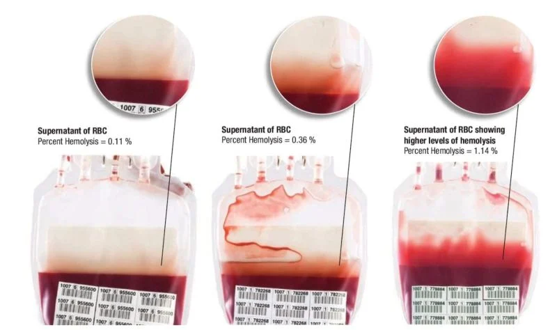 Tareq Abadl։ Hemolysis in Blood Bags and Its Dangers in Transfusion 1 Tareq Abadl։ Hemolysis in Blood Bags and Its Dangers in Transfusion