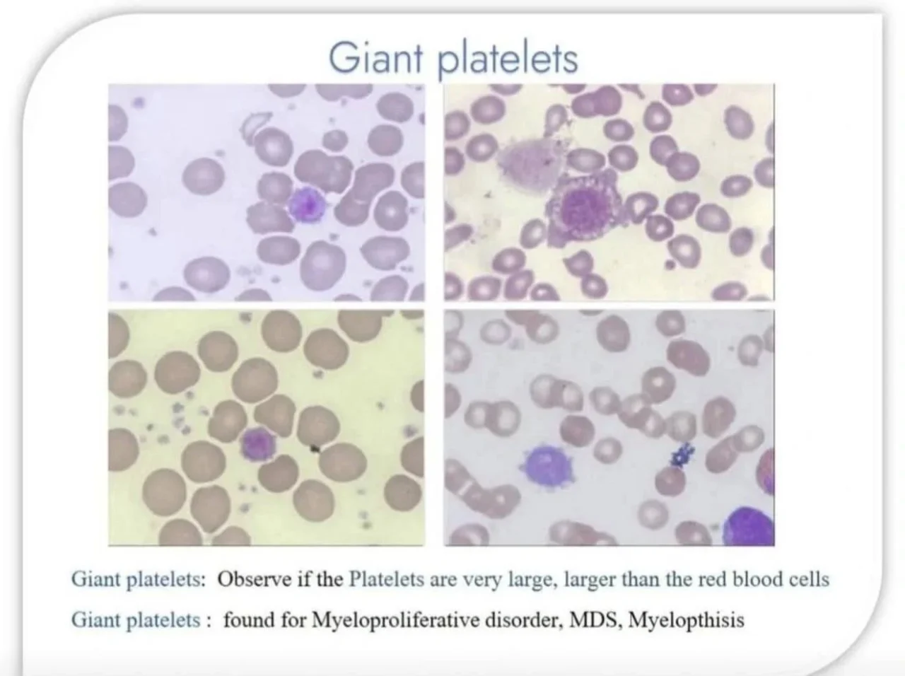 Seema Dawood: Morphologic Differences Between Platelet Types