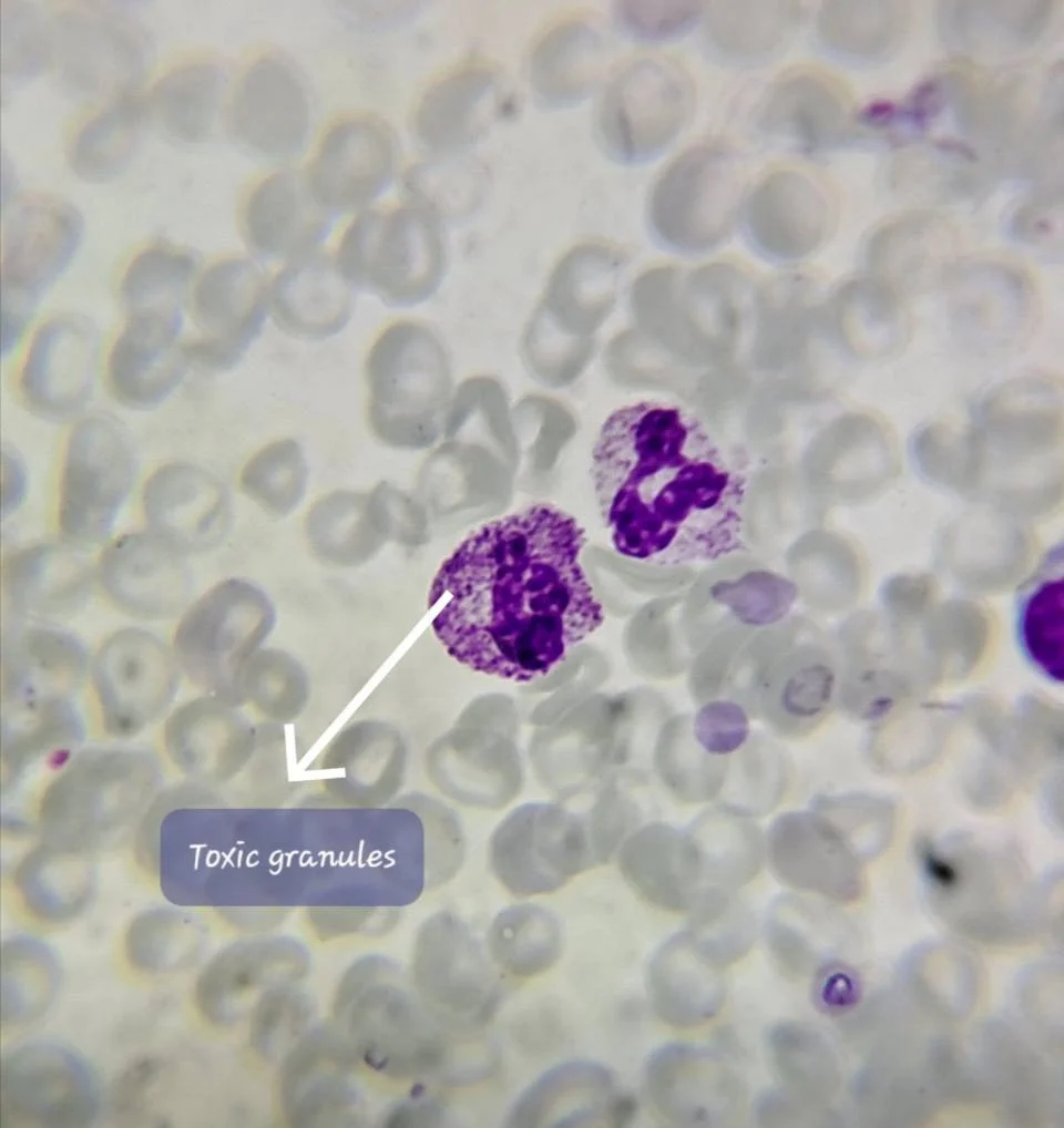 Smitirupa Mishra: Early Clues Lie in Neutrophil Morphology