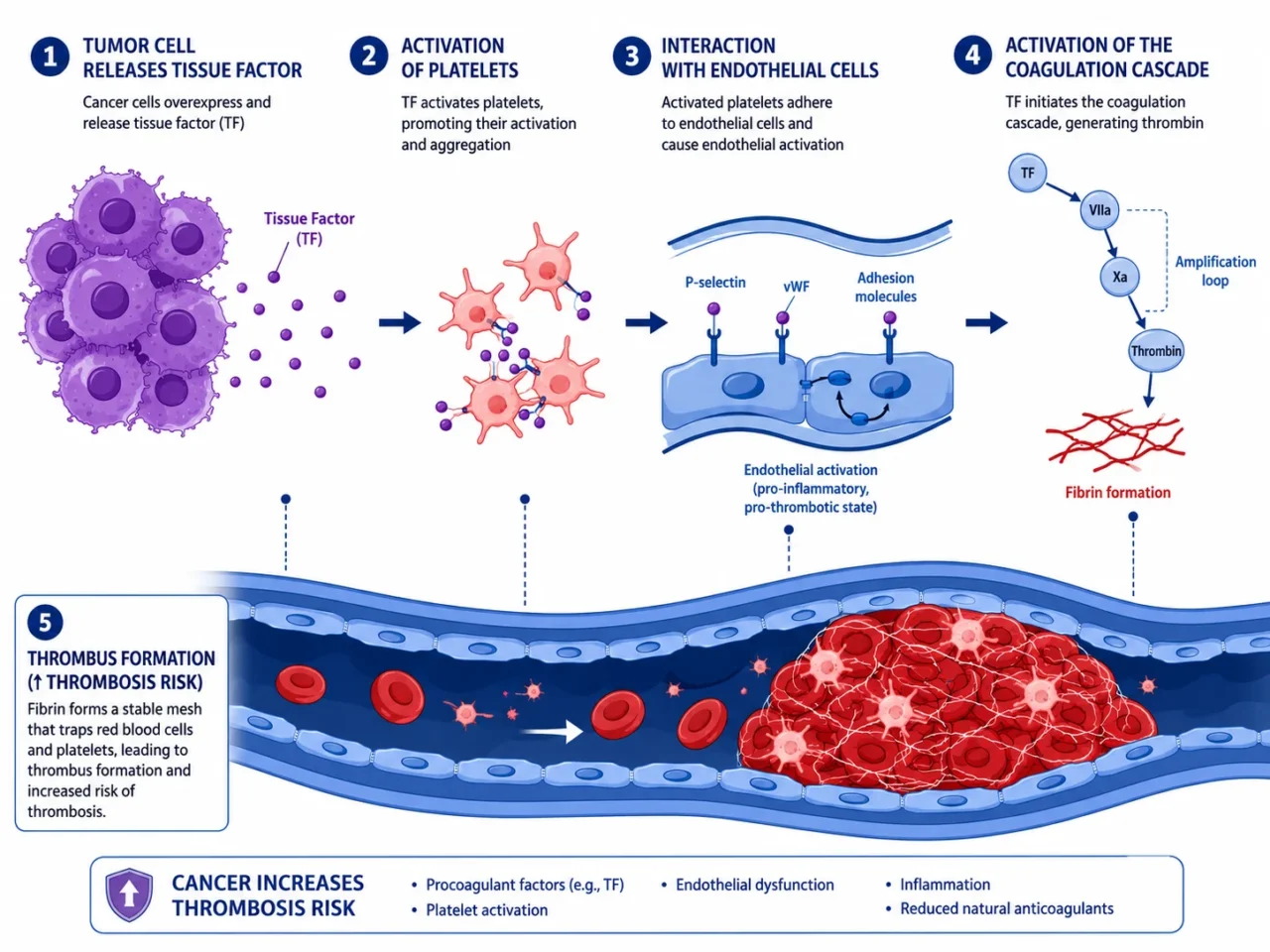 Thrombosis in Cancer Patients: Why It Happens and How We Treat It Today