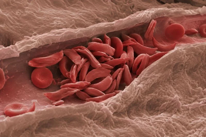 Maxime Dely: Raising Awareness and Improving Diagnosis of Sickle Cell Disease in France 1 Maxime Dely