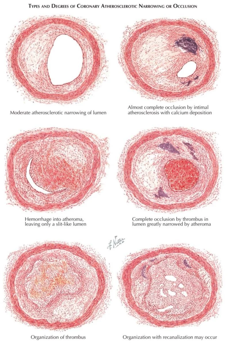 Zain Khalpey: The Path From Atherosclerosis to Heart Attack