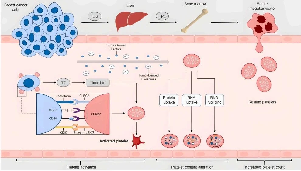 Mohammad Reza Moghaddasnejad: Platelet Activation as a Key Driver of Breast Cancer Progression