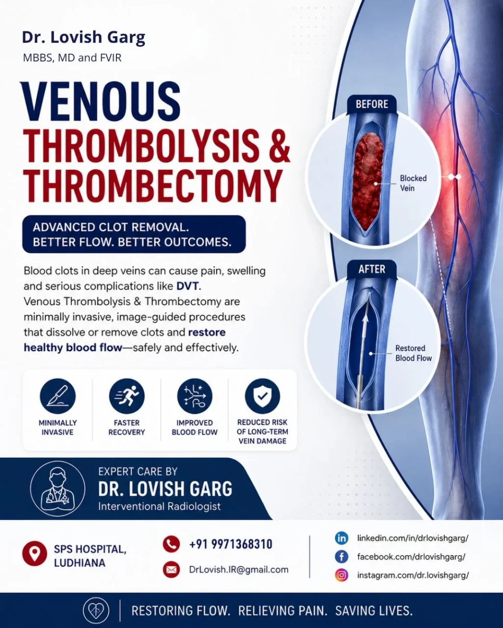 Lovish Garg: Restoring Venous Flow Through Catheter-Directed Thrombus Removal