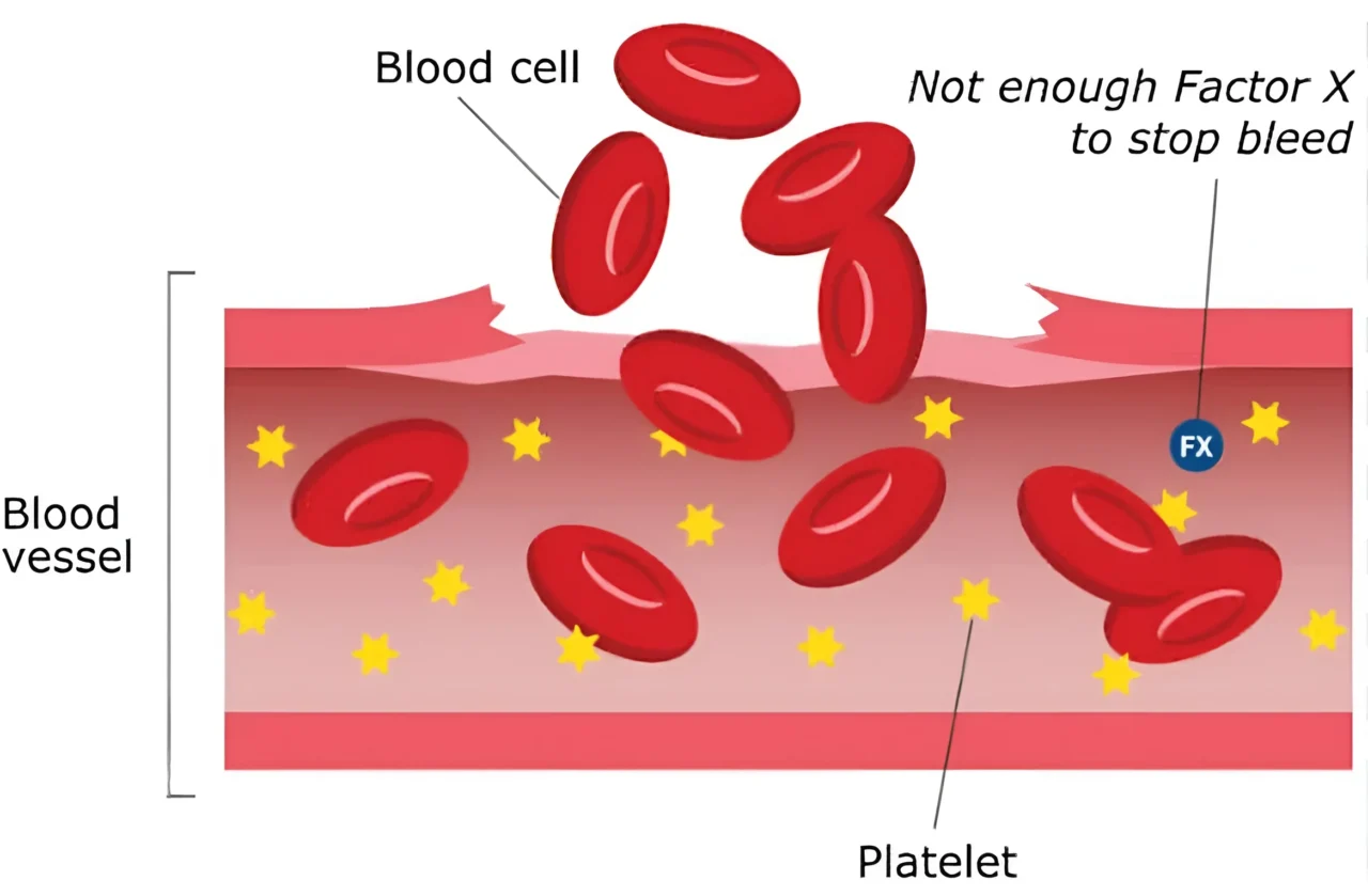 Understanding Factor X Deficiency - ICHCC 1 ICHCC