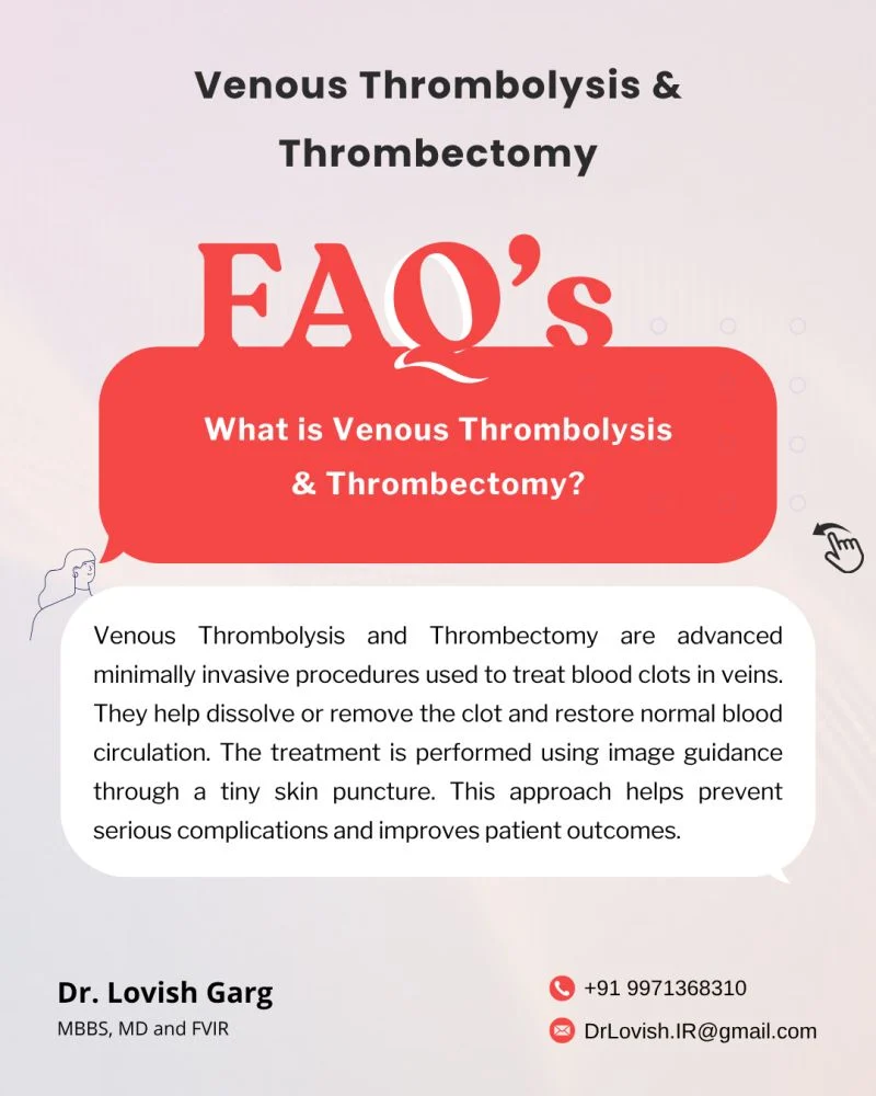 Lovish Garg: Advances in Endovascular Treatment for Deep Vein Thrombosis 1 Lovish Garg: Advances in Endovascular Treatment for Deep Vein Thrombosis