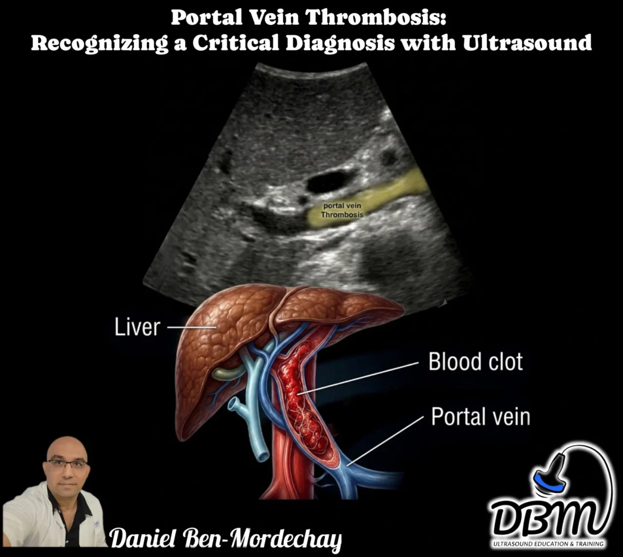 Daniel Ben-Mordechay: Portal Vein Thrombosis - Recognizing a Potentially Life-Threatening Diagnosis with Ultrasound