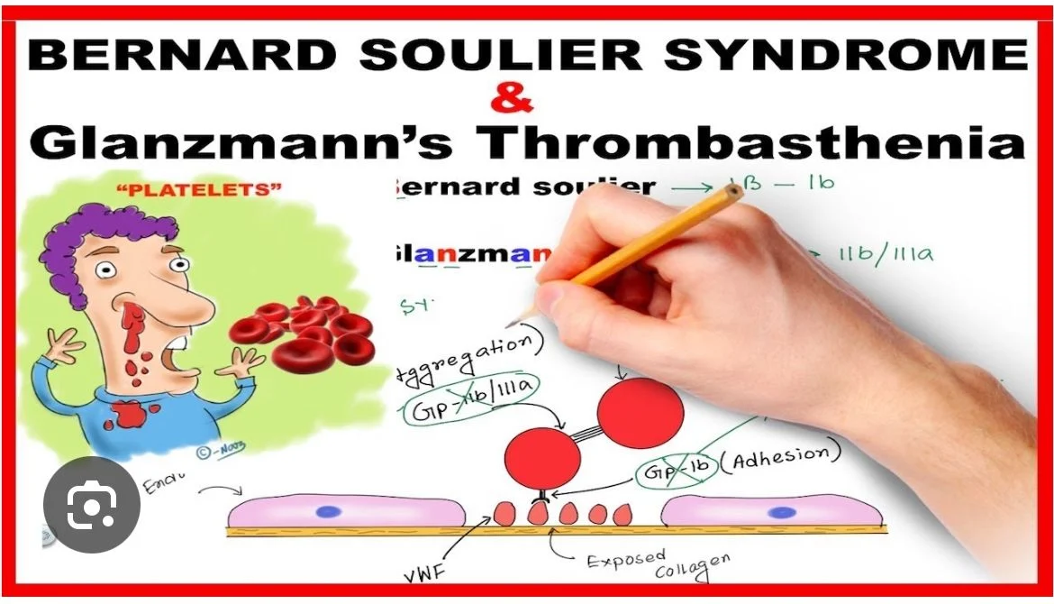 An Overview of Bernard–Soulier Syndrome - ICHCC 1 An Overview of Bernard–Soulier Syndrome - ICHCC