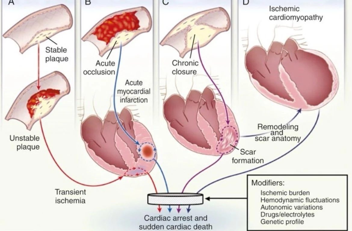 Zain Khalpey: Understanding the Mechanisms of Sudden Cardiac Death 1 Zain Khalpey: Understanding the Mechanisms of Sudden Cardiac Death