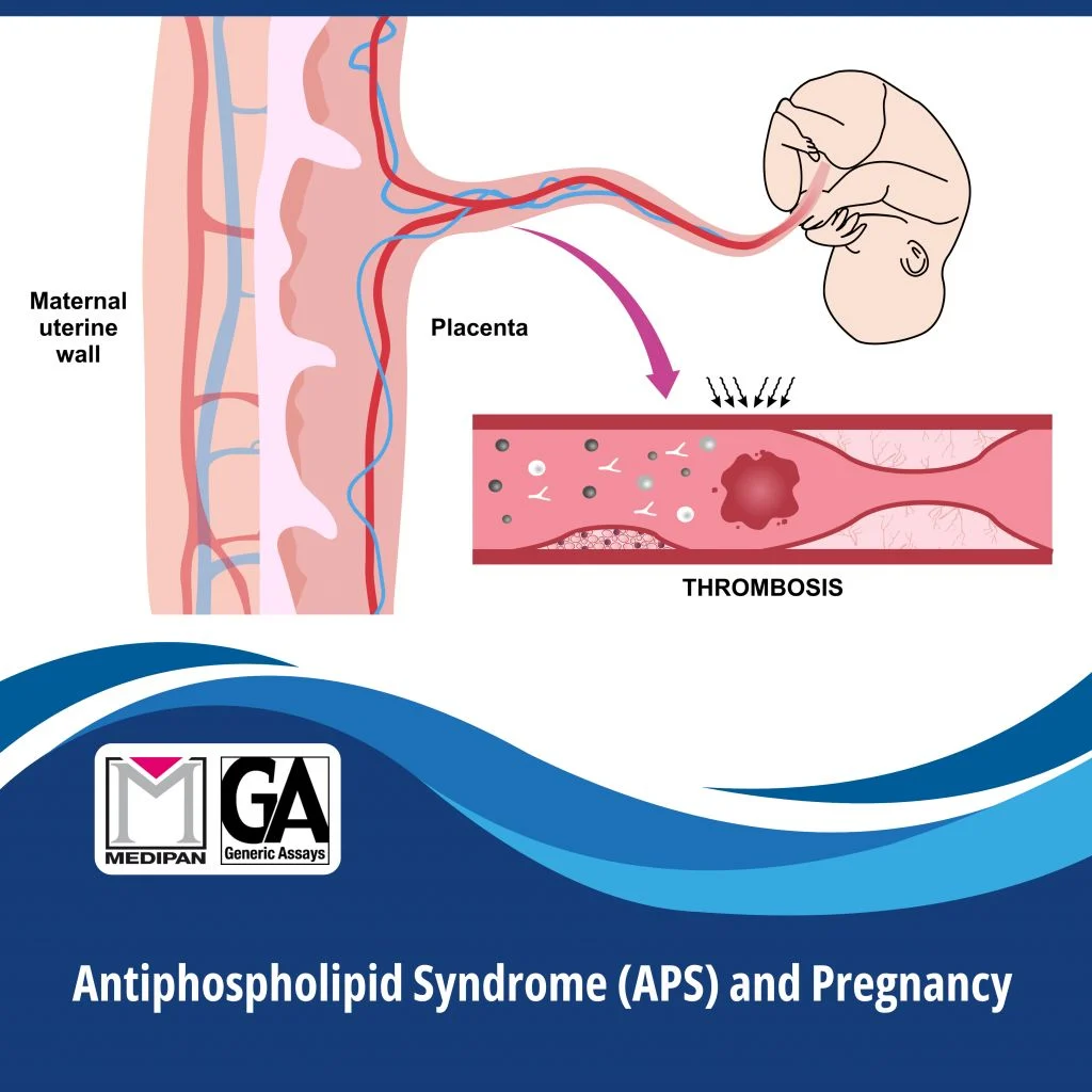 Haileraguel Hailemichael: Antiphospholipid Syndrome Testing - When Blood Clots Point to an Autoimmune Cause