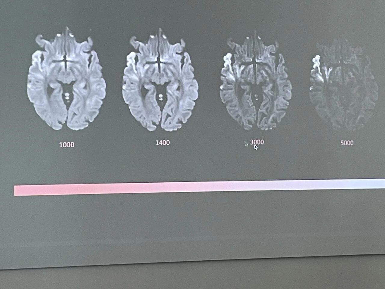 Farid Abedrabbo: How High b-Values Improve Ischemia Detection