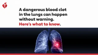 Veronica Sanchez: Did You Know That Acute Pulmonary Embolism Can Be Sudden and Serious?