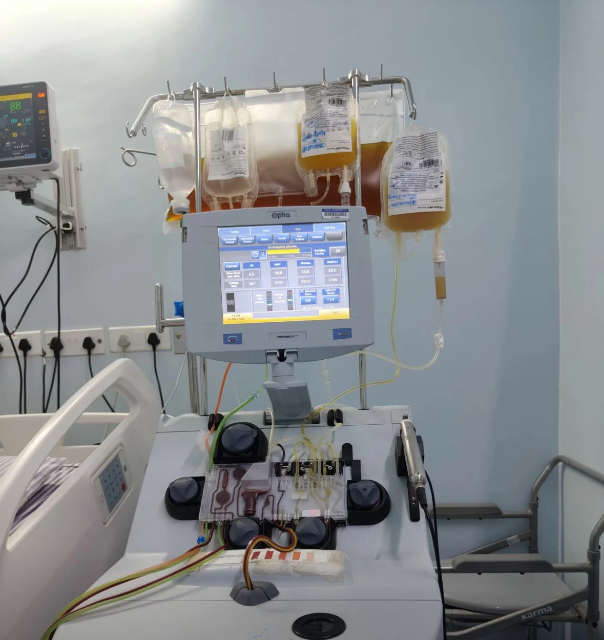Sukanto Paul: Therapeutic Plasma Exchange as an Extracorporeal Liver Support Therapy 1 Sukanto Paul: Therapeutic Plasma Exchange as an Extracorporeal Liver Support Therapy