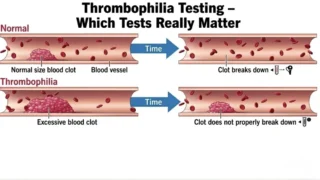 Which Thrombophilia Tests Really Matter? - ICHCC