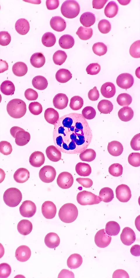 Muhammad Numan: Normal MCV Does Not Exclude B12 Deficiency