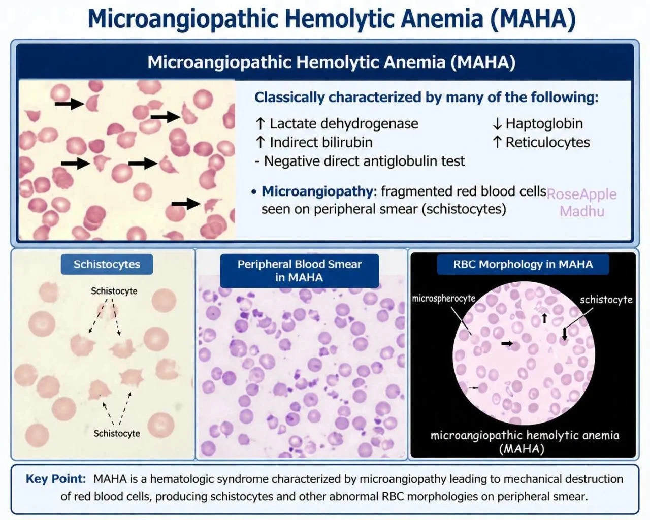 Omar Adwan: The Diagnostic Value of Schistocytes in Hemolytic Disorders