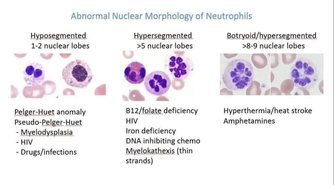 Seema Dawood: Abnormal Nuclear Morphology of Neutrophil 