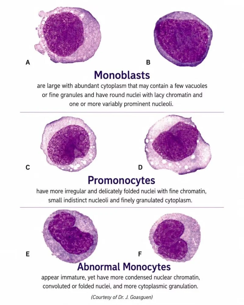 Saoud Hassan: Identifying Monocytic Precursors Under the Microscope 1 Saoud Hassan: Identifying Monocytic Precursors Under the Microscope