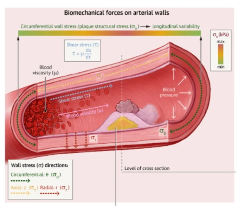 Ney Carter Borges: Biomechanics of Plaque Erosion in ACS