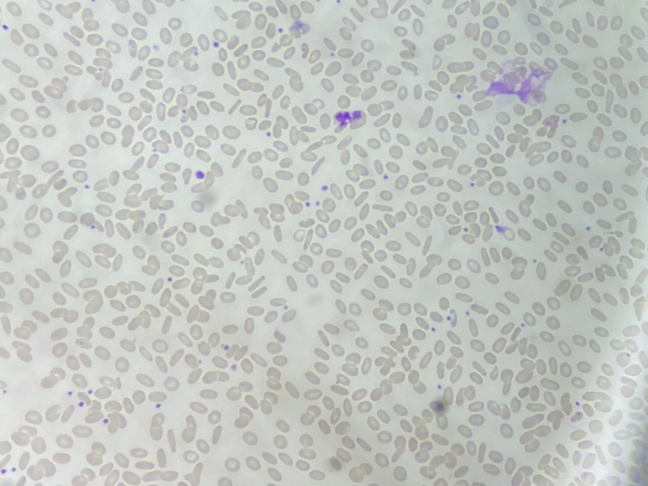 Everton Amorim: The Diagnostic Significance of Elliptocytosis
