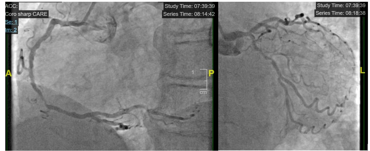 Irma Bagdoniene: The Silent Progression of Coronary Artery Disease