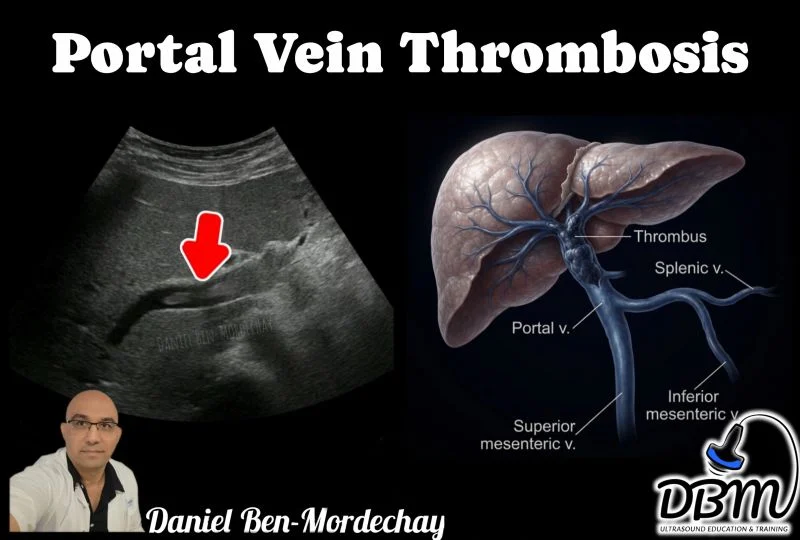 Daniel Ben-Mordechay: Portal Vein Thrombosis Every POCUS User Should Recognize 1 Daniel Ben-Mordechay: Portal Vein Thrombosis Every POCUS User Should Recognize