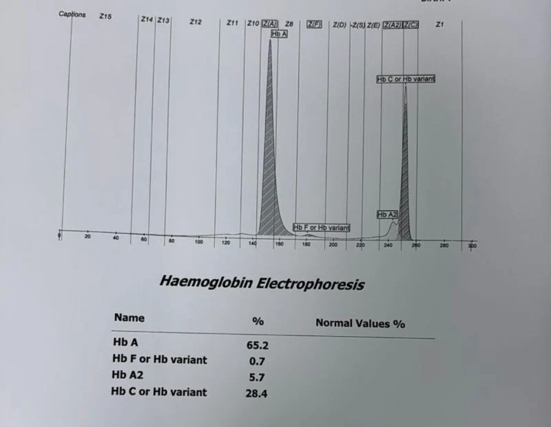 Mona Alfaraj: What Does This HbA₂ Pattern Suggest? 1 Mona Alfaraj: What Does This HbA₂ Pattern Suggest?