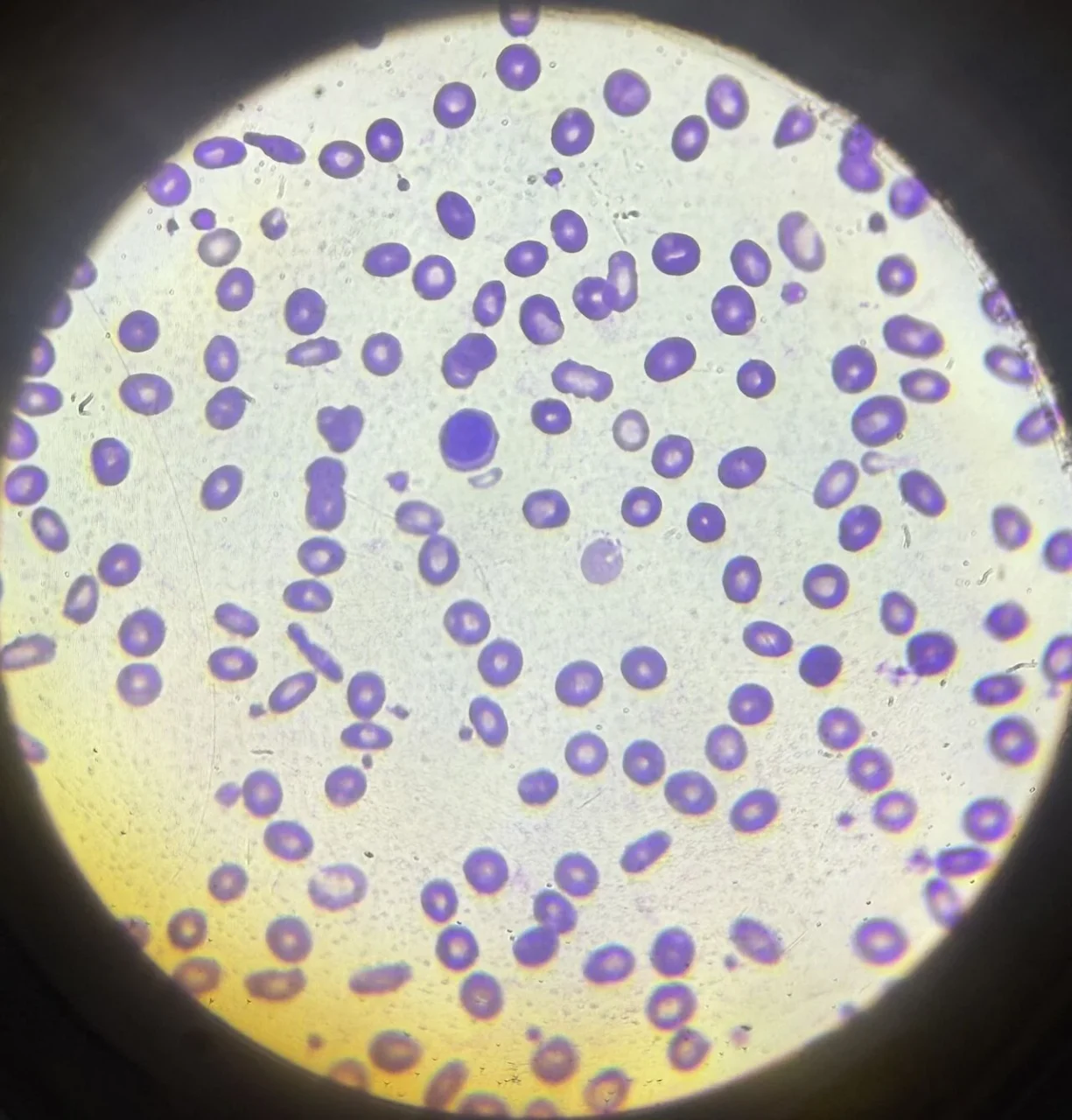 Mili Jain: Understanding Microcytic Hypochromic Anemia