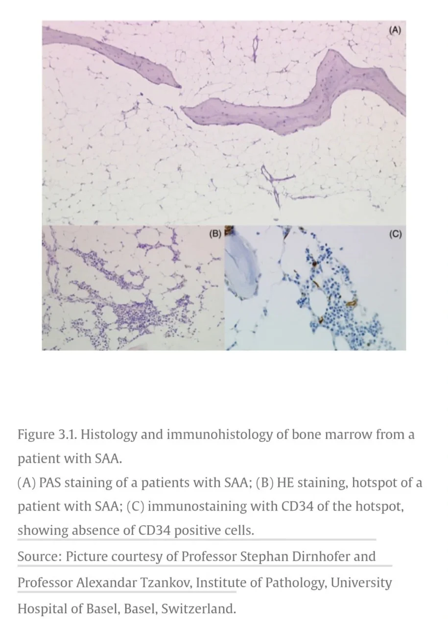 Sally Mandour: The Diagnostic Challenge of Hypocellular Bone Marrow Failure