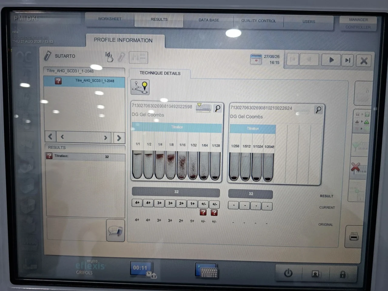 Reza Hafidz Irawan։ Automated Antibody Titration With Erytra Eflexis 1 Reza Hafidz Irawan։ Automated Antibody Titration With Erytra Eflexis