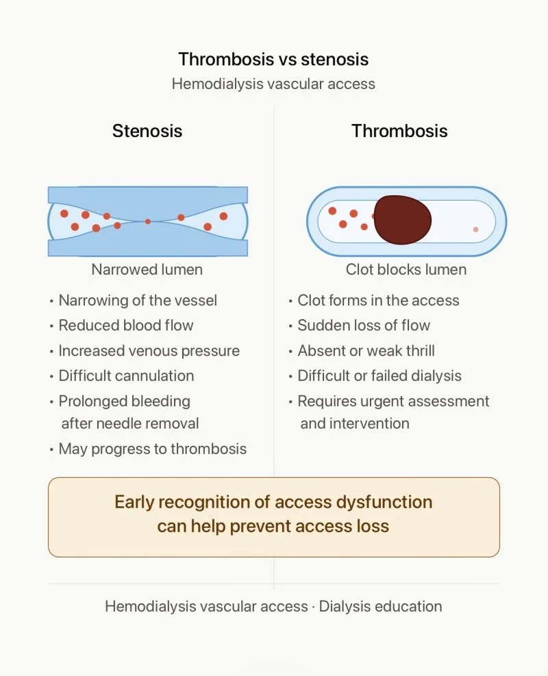 Safa Chenganath: Stenosis vs Thrombosis - Hemodialysis Vascular Access 1 Safa Chenganath: Stenosis vs Thrombosis - Hemodialysis Vascular Access