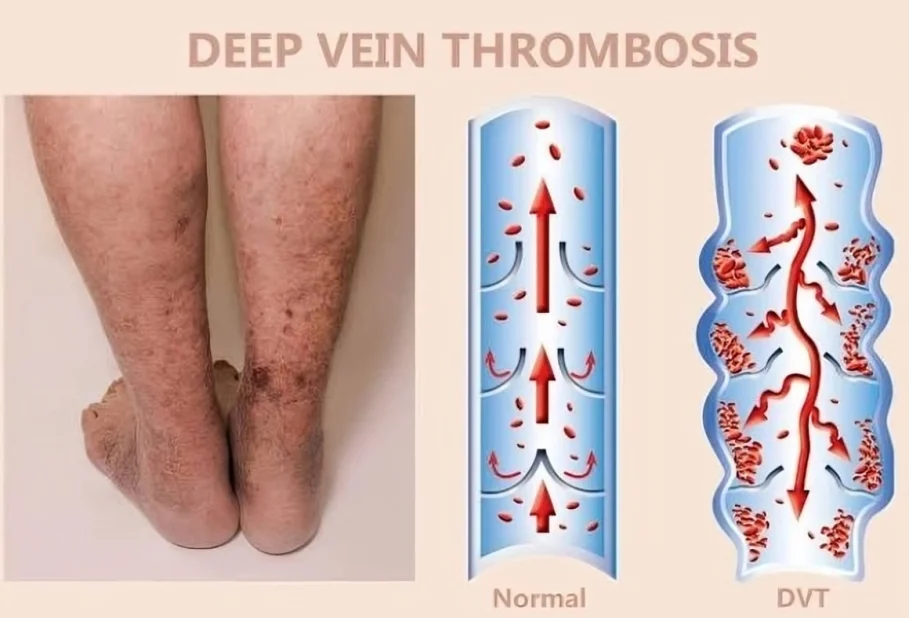 Precious Cosmas: Sonographic Features and Practical Approach to Deep Vein Thrombosis Assessment