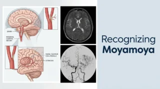 Elias Lee։ Beyond MCA Stenosis - Recognizing Moyamoya