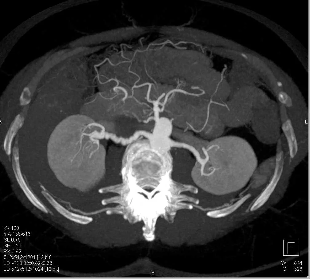 Rishabh Jain: Renal Artery FMD Is Managed With Balloon Angioplasty Alone 1 Rishabh Jain