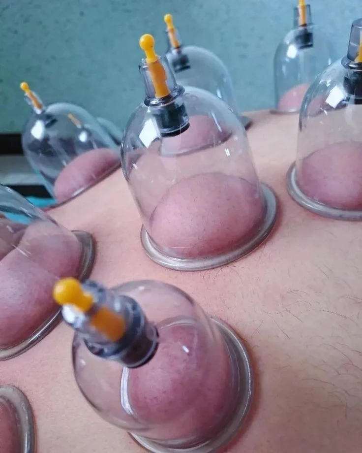 Sumyea Kabir: Wet Hijama and Blood Donation Why Deferral Matters