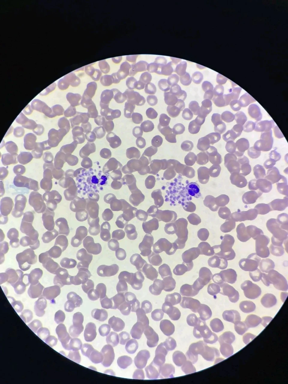 Enewa Onoja: Platelet Satellitism Phenomenon, Three Misleading Counts 1 Enewa Onoja