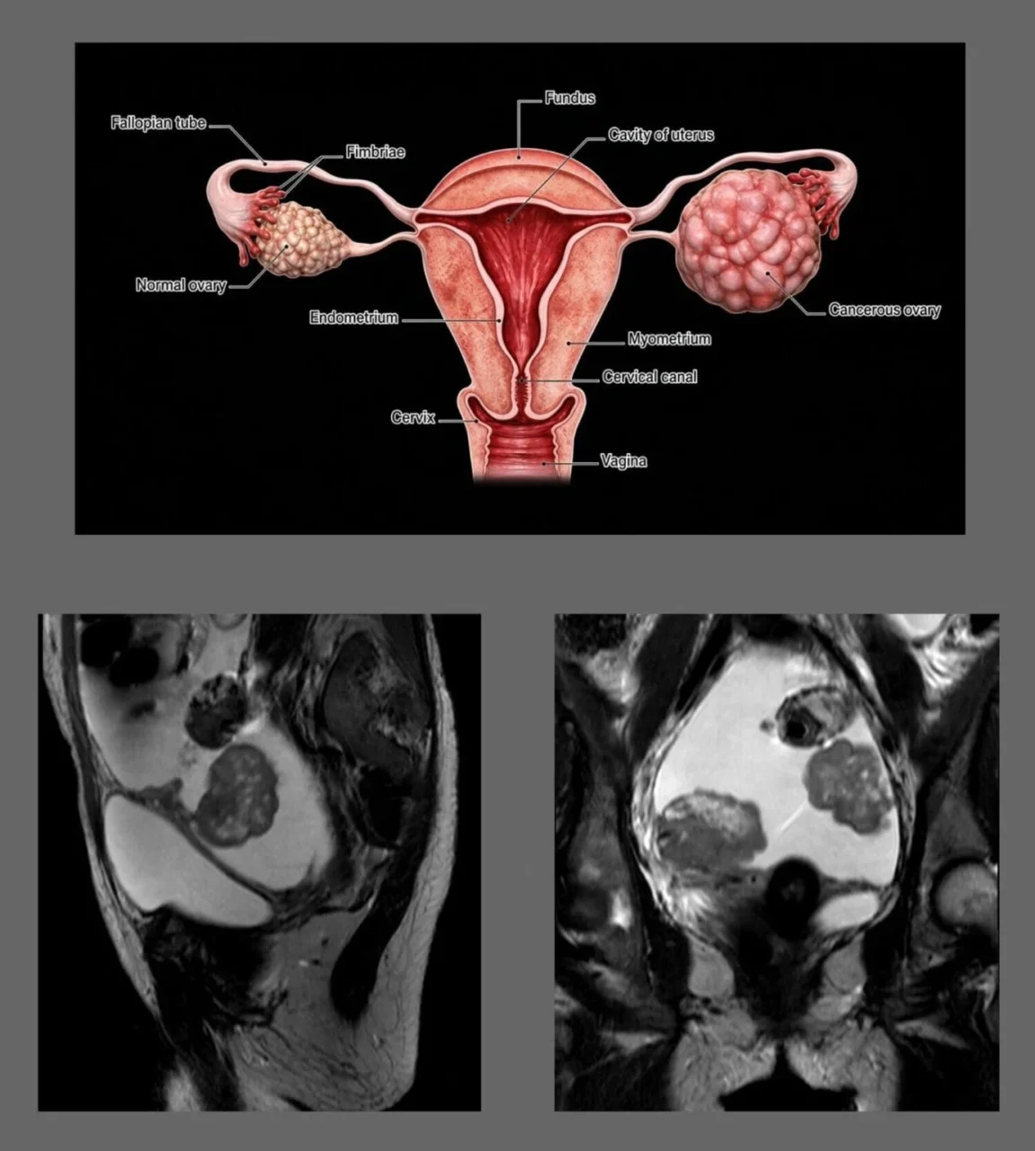 Anis Mahjoubi: MRI Findings of Krukenberg Tumors 1 Anis Mahjoubi: MRI Findings of Krukenberg Tumors