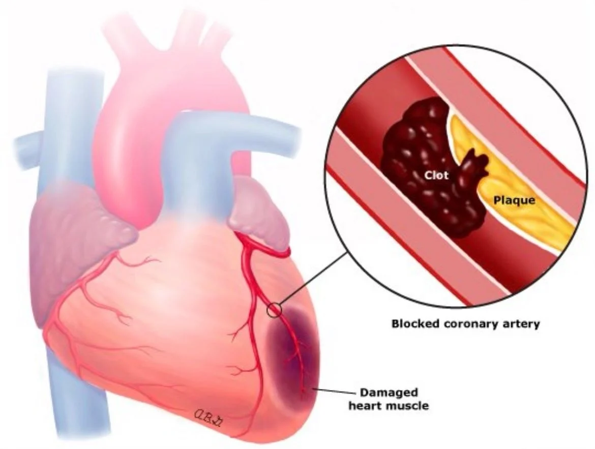 Zain Khalpey: How a Sudden Blockage Causes Myocardial Infarction 1 Zain Khalpey