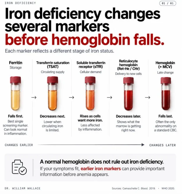 William Wallace: Iron Deficiency Can be Present Before Hemoglobin Falls and Before Anemia Appears 1 William Wallace: Iron Deficiency Can be Present Before Hemoglobin Falls and Before Anemia Appears