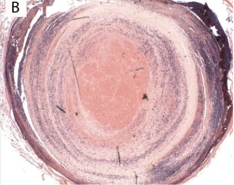 Mario D. Caldararo: Are Lines of Zahn Pathognomonic for Antemortem Thrombosis?
